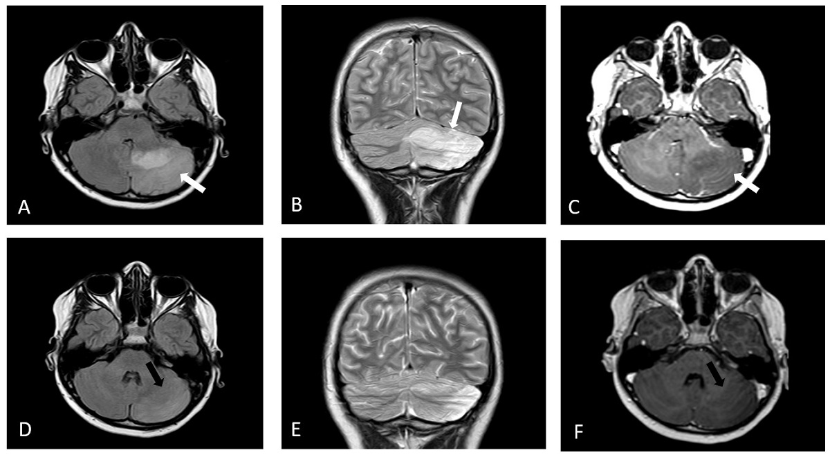 Figura 1. Cerebelitis aguda. Evolución de la afectación cerebelosa en el caso 1. (A) Axial FLAIR. (B) Coronal FSE T2. (C) Axial eco de gradiente T1 con contraste. Afectación difusa de folias cerebelosa y sustancia blanca en hemisferio cerebeloso izquierdo con hiperseñal en secuencia FLAIR y T2 y leve realce de las folias cerebelosas tras contraste que alcanza el vermis y presenta efecto de masa sobre el IV ventrículo (flechas blancas). Control a los 10 días. (D) Axial FLAIR. (E) Coronal FSE T2. (F) Axial eco de gradiente T1 con contraste. Marcada disminución de la afectación de hemisferio cerebeloso izquierdo que no presenta efecto de masa sobre el IV ventrículo ni realza tras contraste (flechas negras).